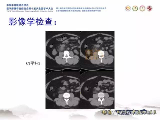 【病例】腹膜后巨淋巴结增生症1例CT