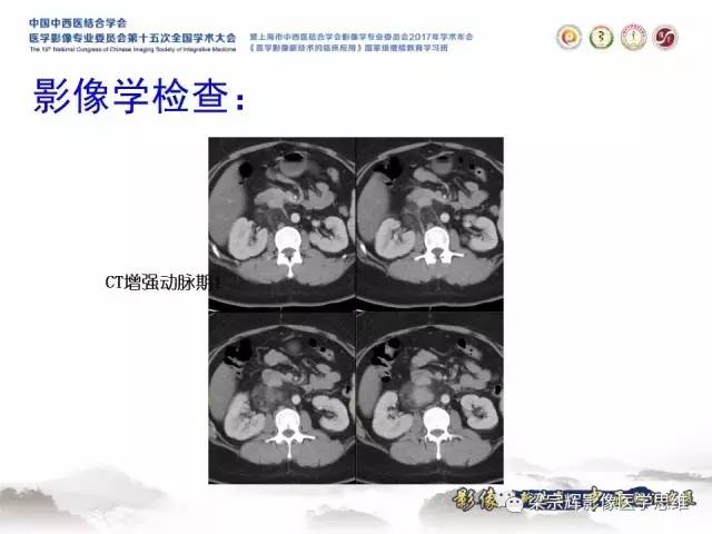 【病例】腹膜后巨淋巴结增生症1例CT