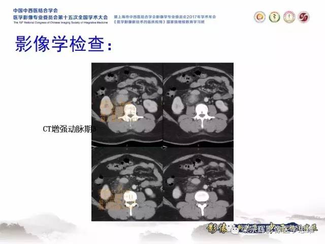 【病例】腹膜后巨淋巴结增生症1例CT