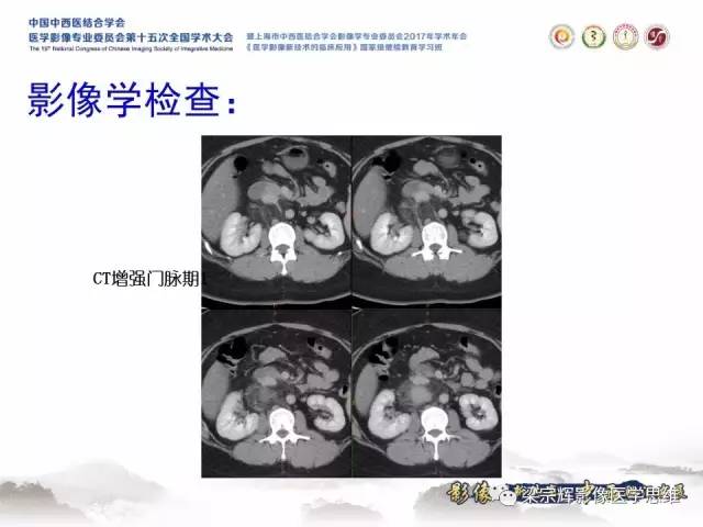 【病例】腹膜后巨淋巴结增生症1例CT