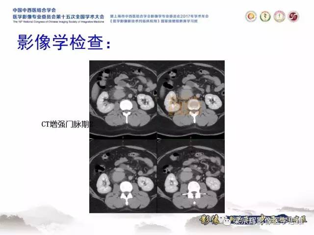 【病例】腹膜后巨淋巴结增生症1例CT