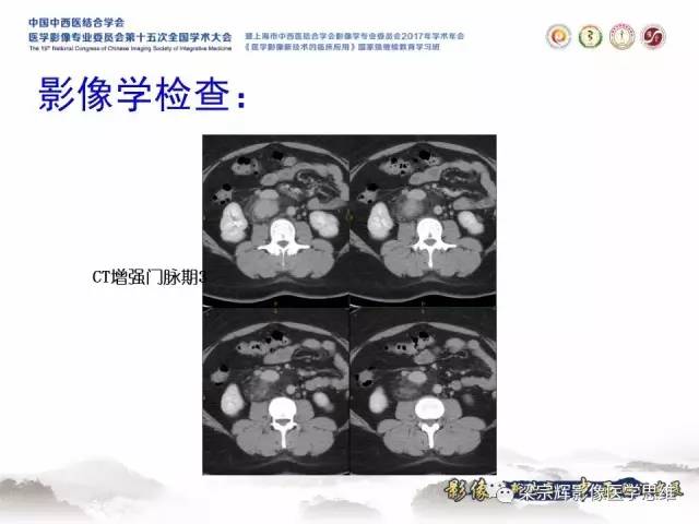 【病例】腹膜后巨淋巴结增生症1例CT