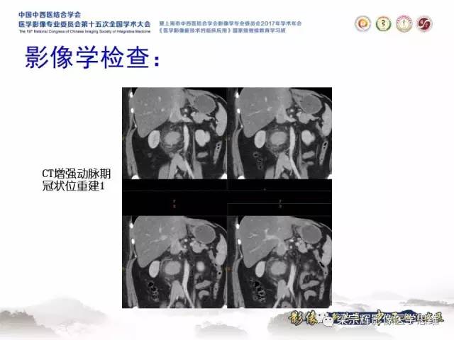 【病例】腹膜后巨淋巴结增生症1例CT