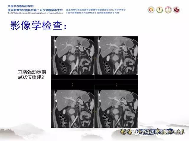 【病例】腹膜后巨淋巴结增生症1例CT