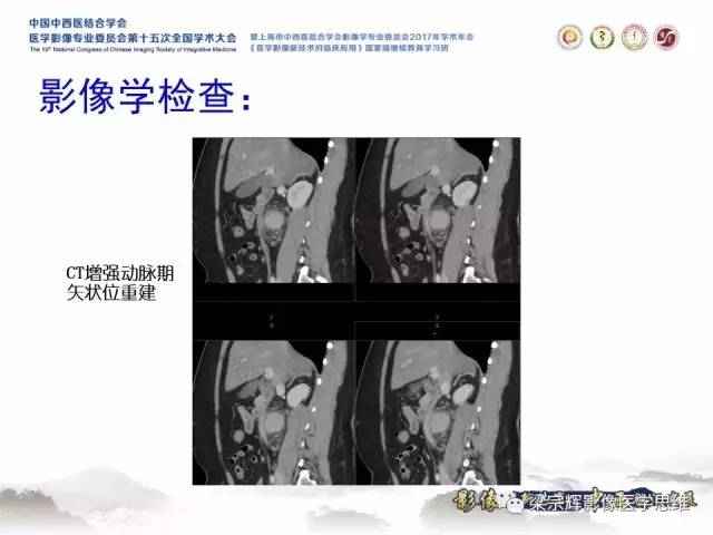 【病例】腹膜后巨淋巴结增生症1例CT