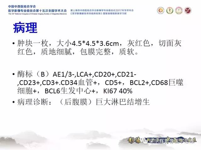 【病例】腹膜后巨淋巴结增生症1例CT