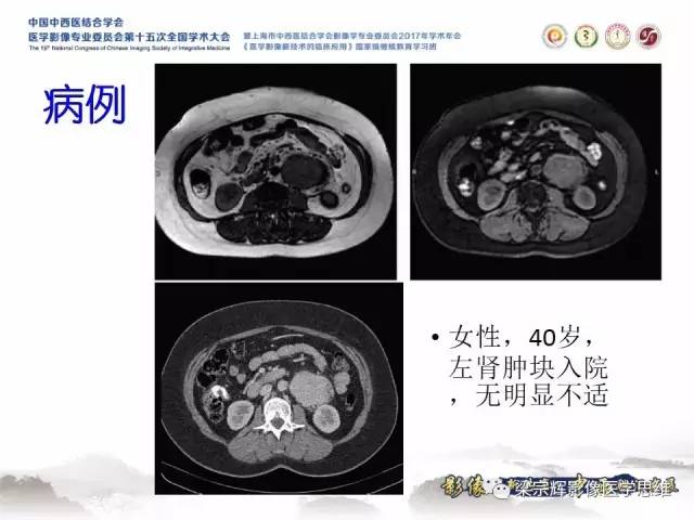 【病例】腹膜后巨淋巴结增生症1例CT