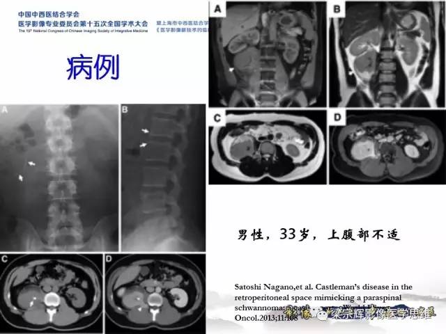 【病例】腹膜后巨淋巴结增生症1例CT