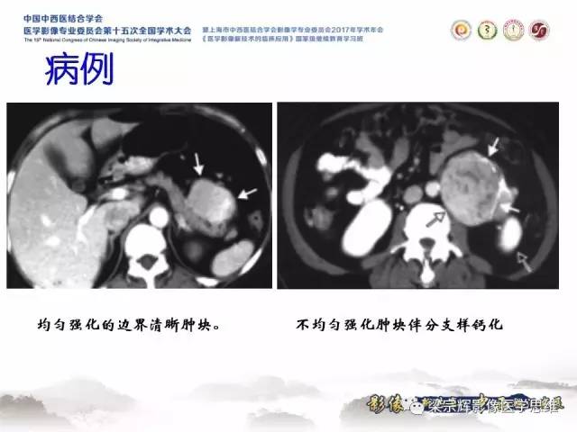 【病例】腹膜后巨淋巴结增生症1例CT