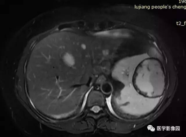 【病例】脾脏错构瘤1例MR影像表现 【病例】脾脏错构瘤1例MR影像表现