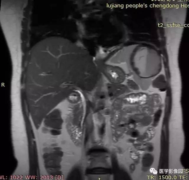 【病例】脾脏错构瘤1例MR影像表现 【病例】脾脏错构瘤1例MR影像表现