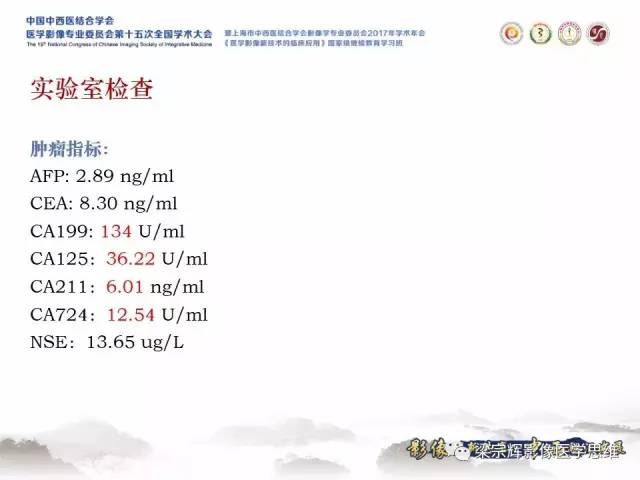 【病例】腹膜后囊腺癌1例CT