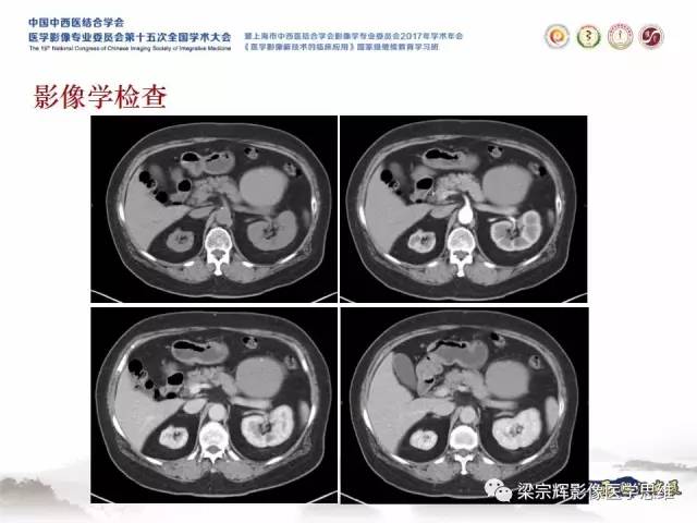 【病例】腹膜后囊腺癌1例CT