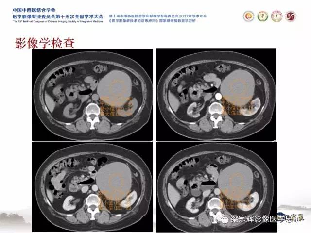 【病例】腹膜后囊腺癌1例CT