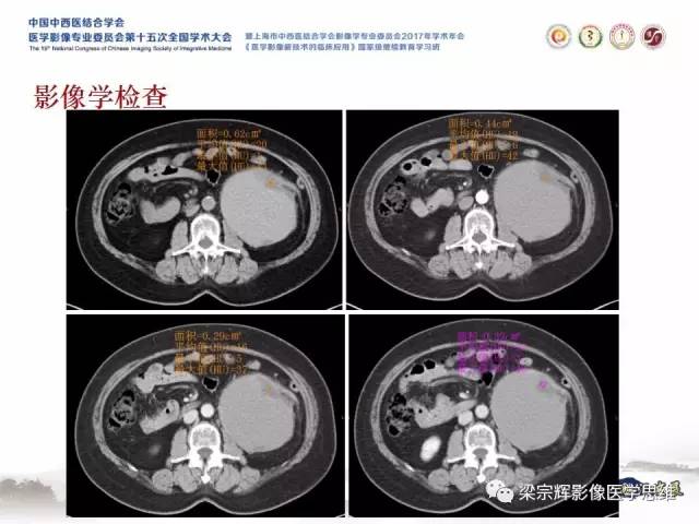 【病例】腹膜后囊腺癌1例CT