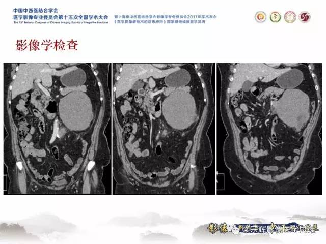 【病例】腹膜后囊腺癌1例CT