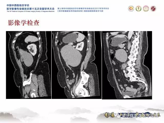 【病例】腹膜后囊腺癌1例CT