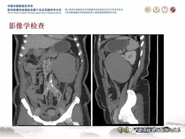 【病例】腹膜后囊腺癌1例CT