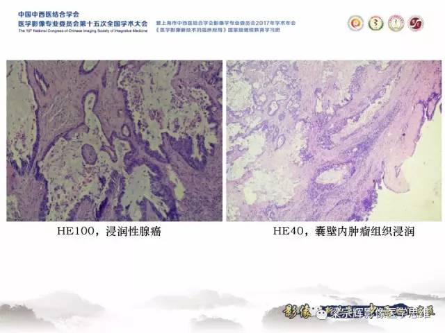 【病例】腹膜后囊腺癌1例CT