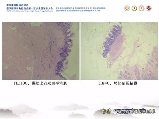 【病例】腹膜后囊腺癌1例CT