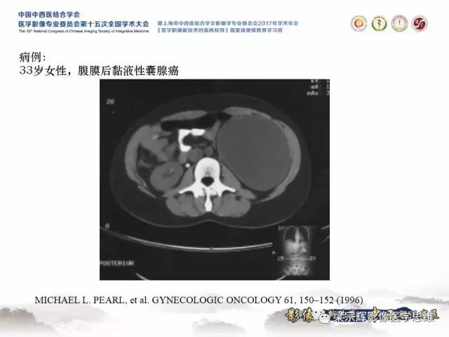 【病例】腹膜后囊腺癌1例CT