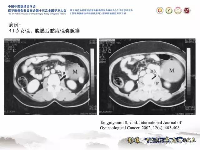 【病例】腹膜后囊腺癌1例CT