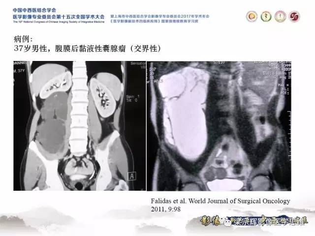 【病例】腹膜后囊腺癌1例CT