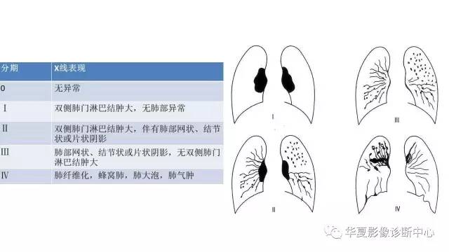 【病例】结节病1例CT影像表现