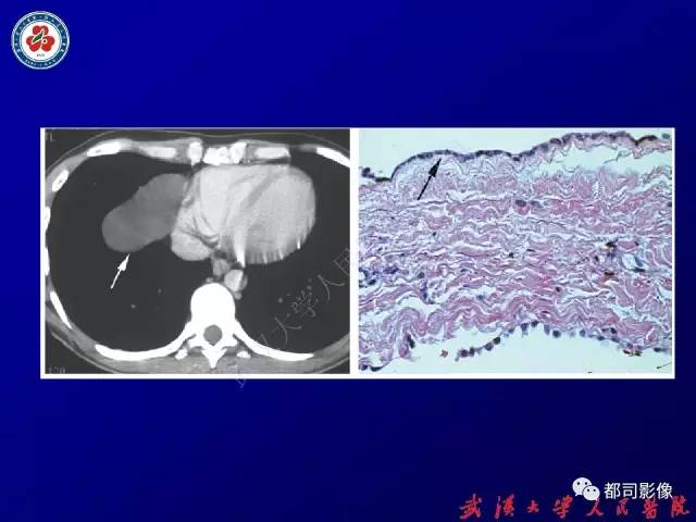 【PPT】纵隔囊性及囊样病变影像学诊断