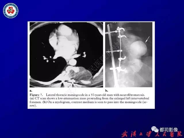 【PPT】纵隔囊性及囊样病变影像学诊断