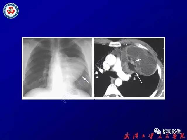 【PPT】纵隔囊性及囊样病变影像学诊断