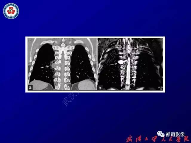 【PPT】纵隔囊性及囊样病变影像学诊断