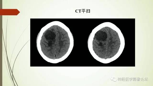 【病例】囊性脑膜瘤2例CT及MR