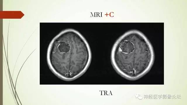 【病例】囊性脑膜瘤2例CT及MR