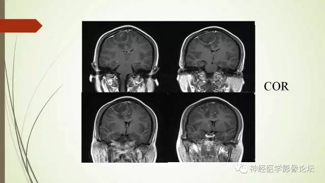 【病例】囊性脑膜瘤2例CT及MR
