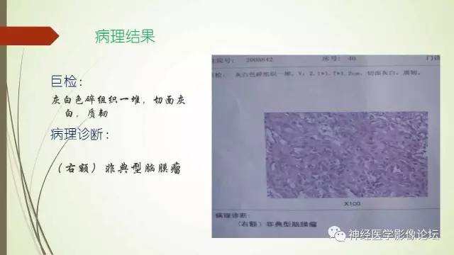 【病例】囊性脑膜瘤2例CT及MR