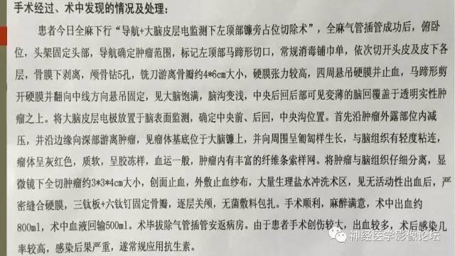 【病例】囊性脑膜瘤2例CT及MR