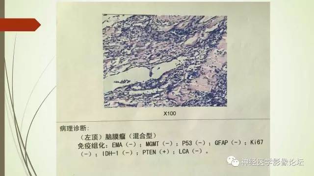 【病例】囊性脑膜瘤2例CT及MR