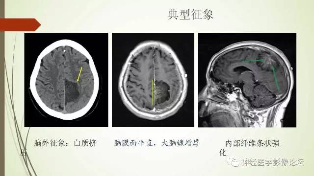 【病例】囊性脑膜瘤2例CT及MR