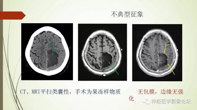 【病例】囊性脑膜瘤2例CT及MR