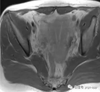 【病例】双子宫双阴道畸形1例MR 【病例】双子宫双阴道畸形1例MR