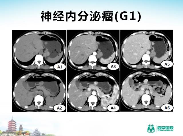 【PPT】胃部少见原发肿瘤的CT诊断
