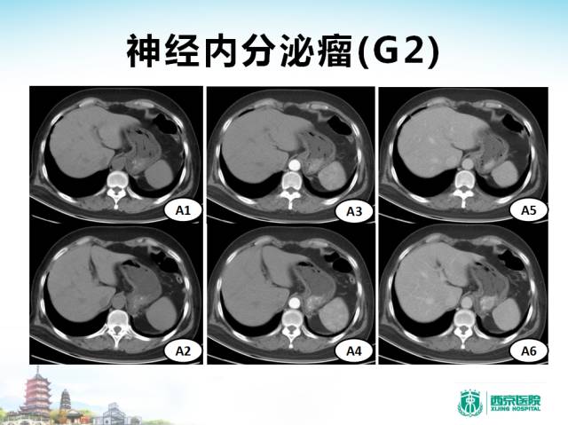 【PPT】胃部少见原发肿瘤的CT诊断