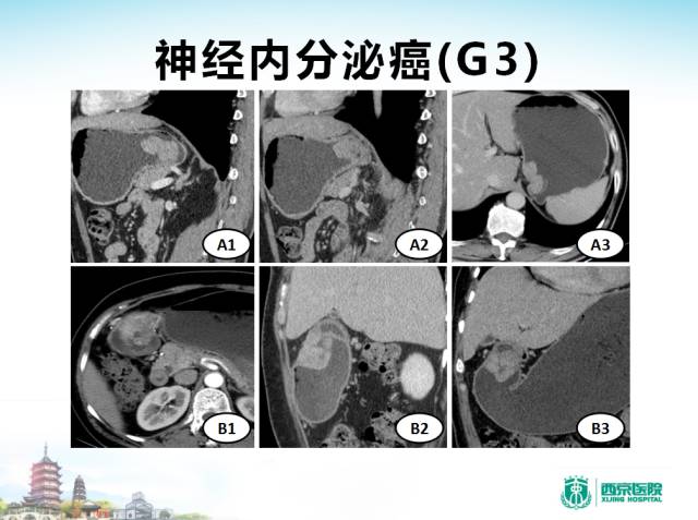 【PPT】胃部少见原发肿瘤的CT诊断