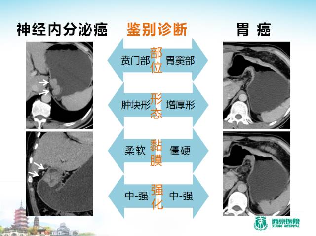 【PPT】胃部少见原发肿瘤的CT诊断