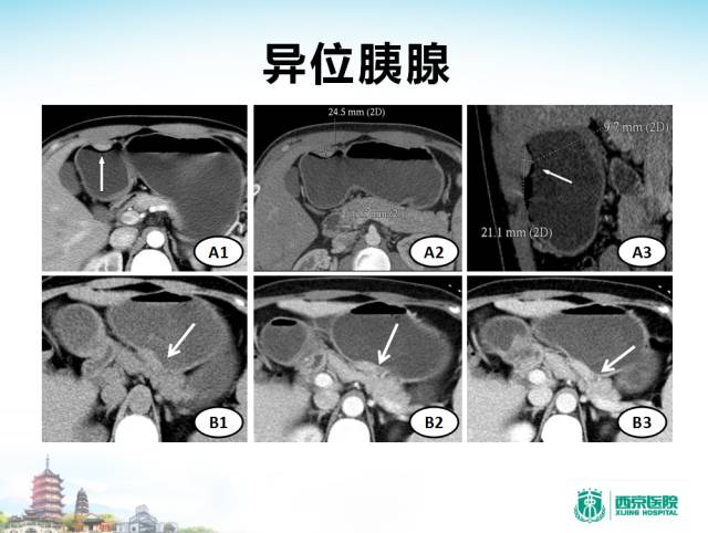【PPT】胃部少见原发肿瘤的CT诊断