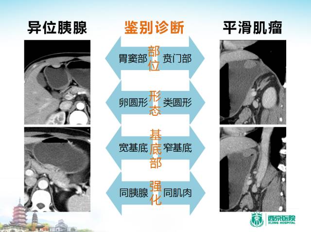 【PPT】胃部少见原发肿瘤的CT诊断