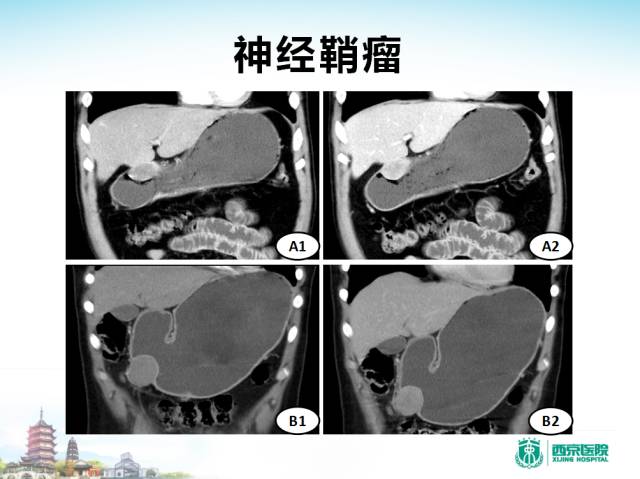 【PPT】胃部少见原发肿瘤的CT诊断