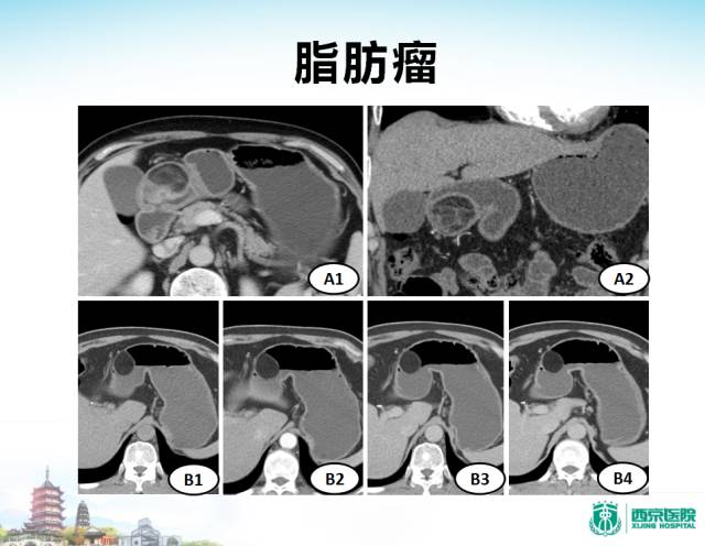 【PPT】胃部少见原发肿瘤的CT诊断