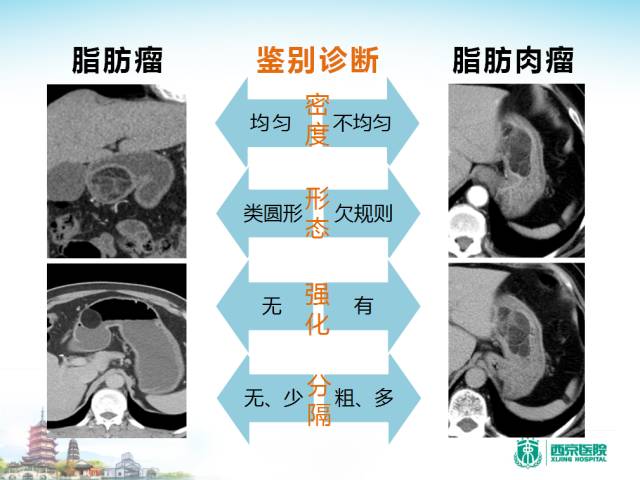 【PPT】胃部少见原发肿瘤的CT诊断